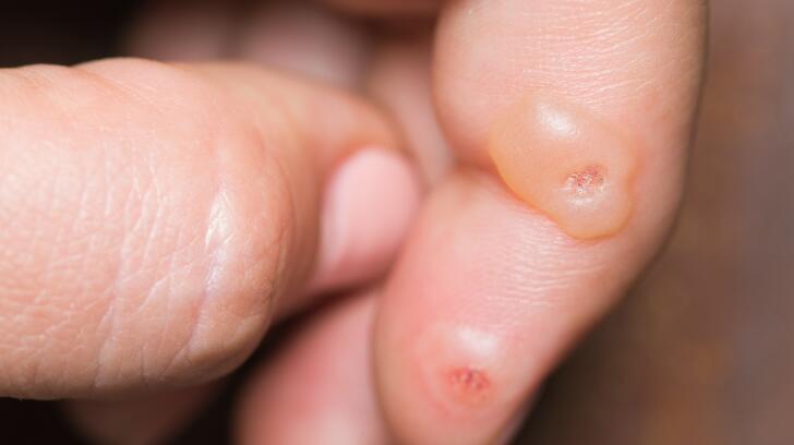 warts on hands keep spreading human papilloma virus nedir belirtileri
