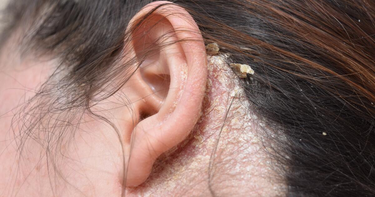 plaque psoriasis behind ears