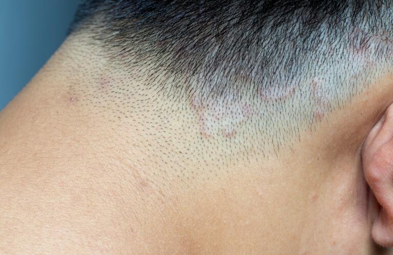 closeup image of tinea capitas (ringworm) on scalp of asian man