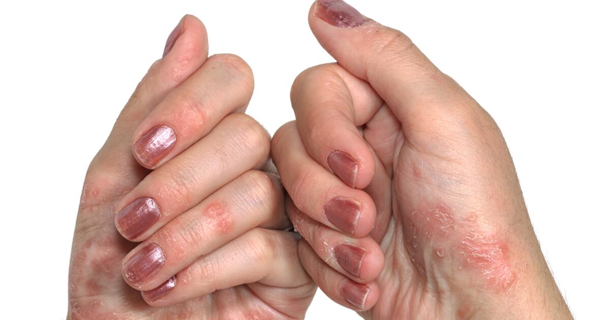 Palm Rash Symptoms Causes Treatments