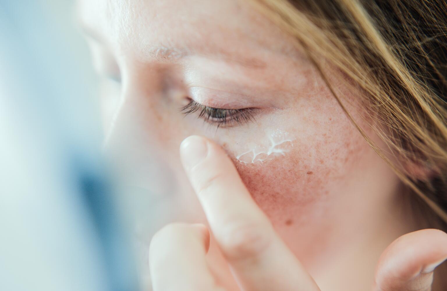 Salicylic Acid for Acne How Salicylic Acid Acne Treatment Works