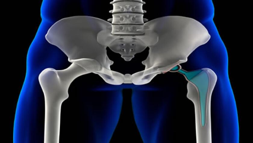 Arthroplasty