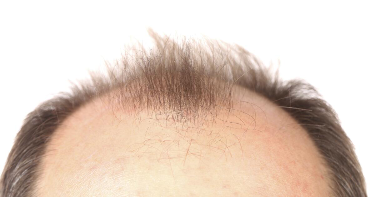 Itchy Scalp Dandruff Symptoms Causes Treatments Diagnosis