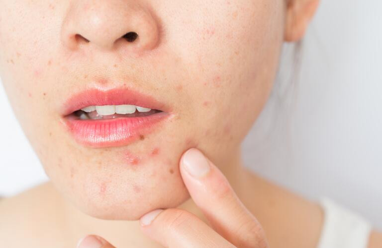 Closeup de femme demi-visage avec des problèmes d'acné. inflammation