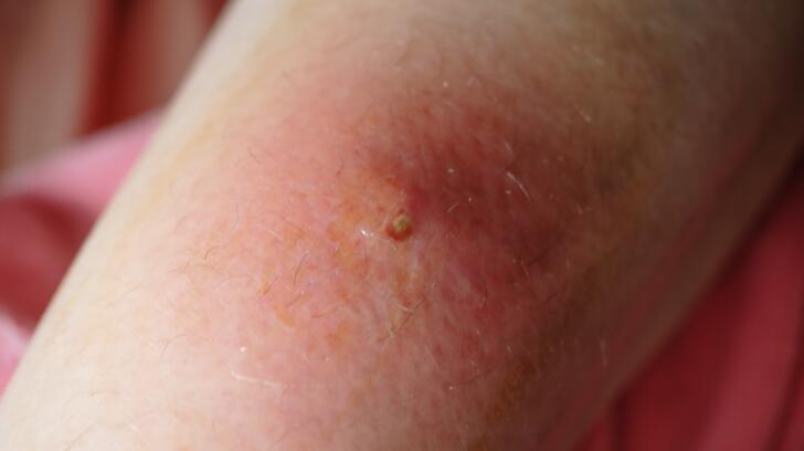 Boils Skin Information 8 Things To Know About Boils
