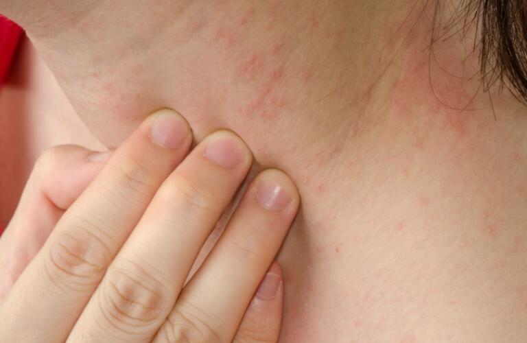 What Is Atopic Dermatitis
