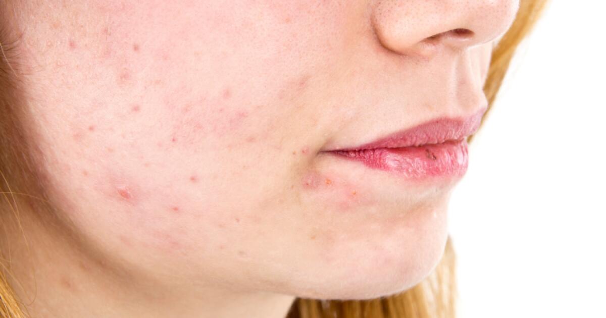 Cheek Rash | Healthgrades