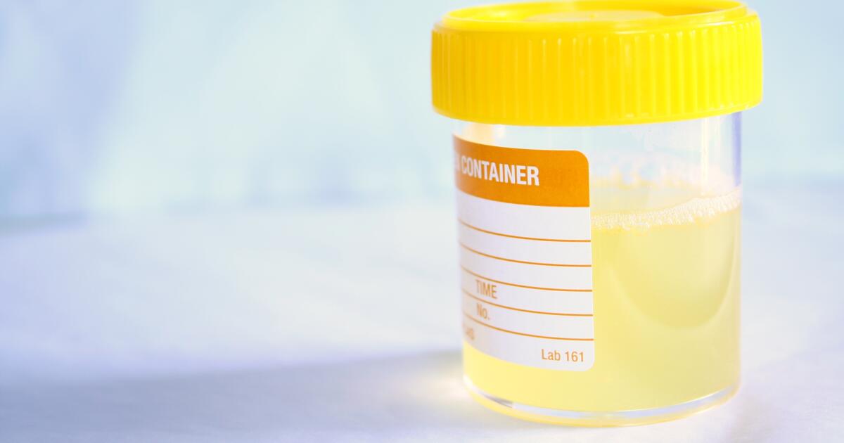 Cloudy Urine Symptoms, Causes, Treatments