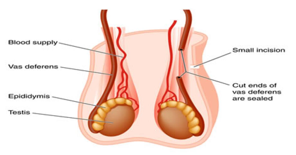 Vasectomy How It S Done Risks What To Expect Vasectomy How It S Done Risks What To Expect