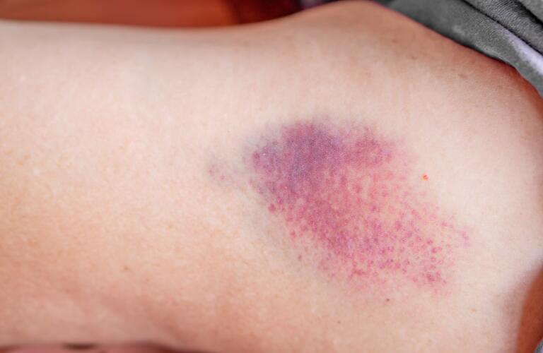 pinpoint bleeding pinpoint bleeding