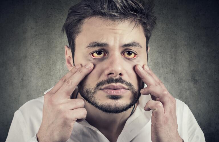 sick man with yellowing eyes as sign of jaundice