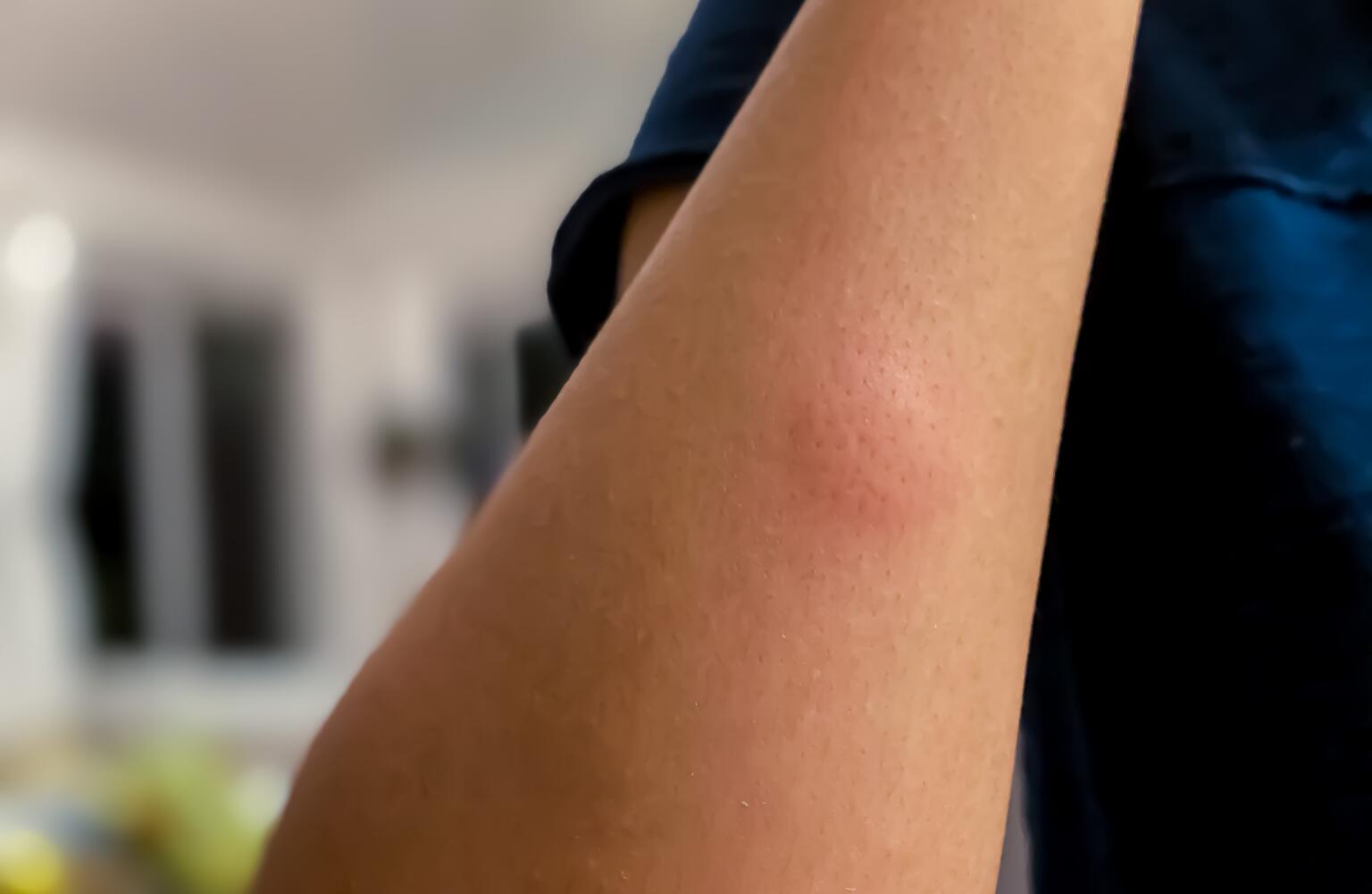 brown recluse spider bite