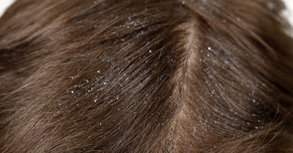 Frequently Asked Questions About Dandruff Causes & Treatment