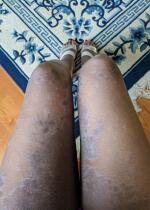 Ashley Wall Eczema 1
