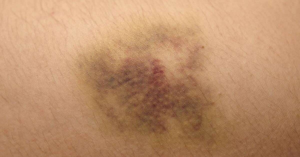 Reason no yellow for bruising Random Bruising: