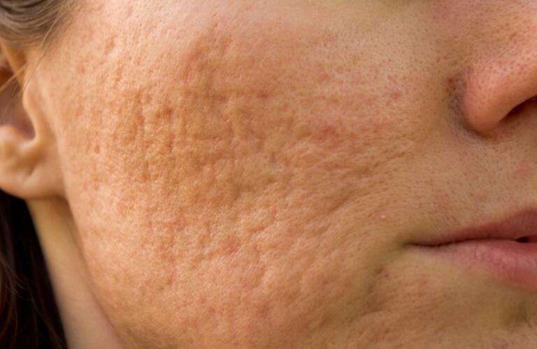 Getting Rid Of Acne Scars