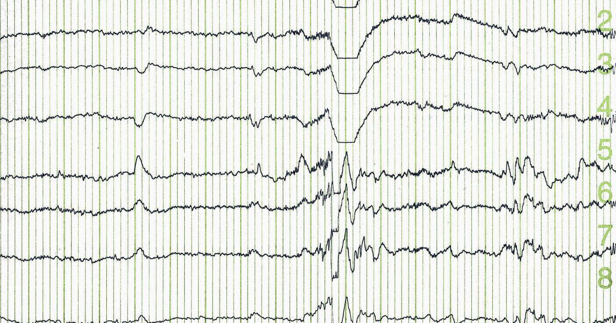 Understanding Your EEG Results Normal & Abnormal EEGs