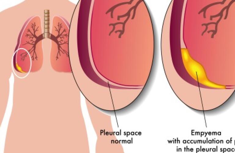 Thoracentesis (pleural tap)