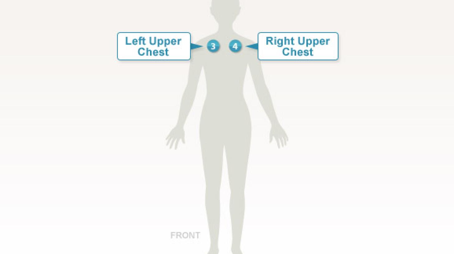 The Tender Points of Fibromyalgia