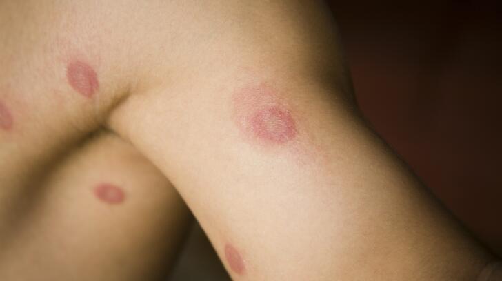 Ringworm Causes 9 Things To Know About Ringworm