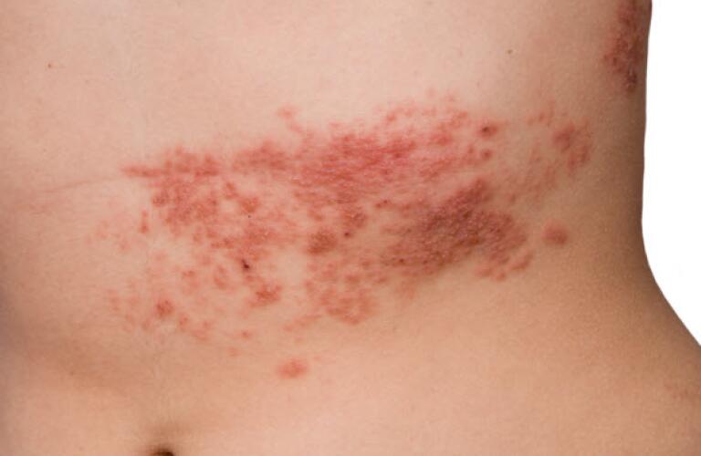 Shingles rash