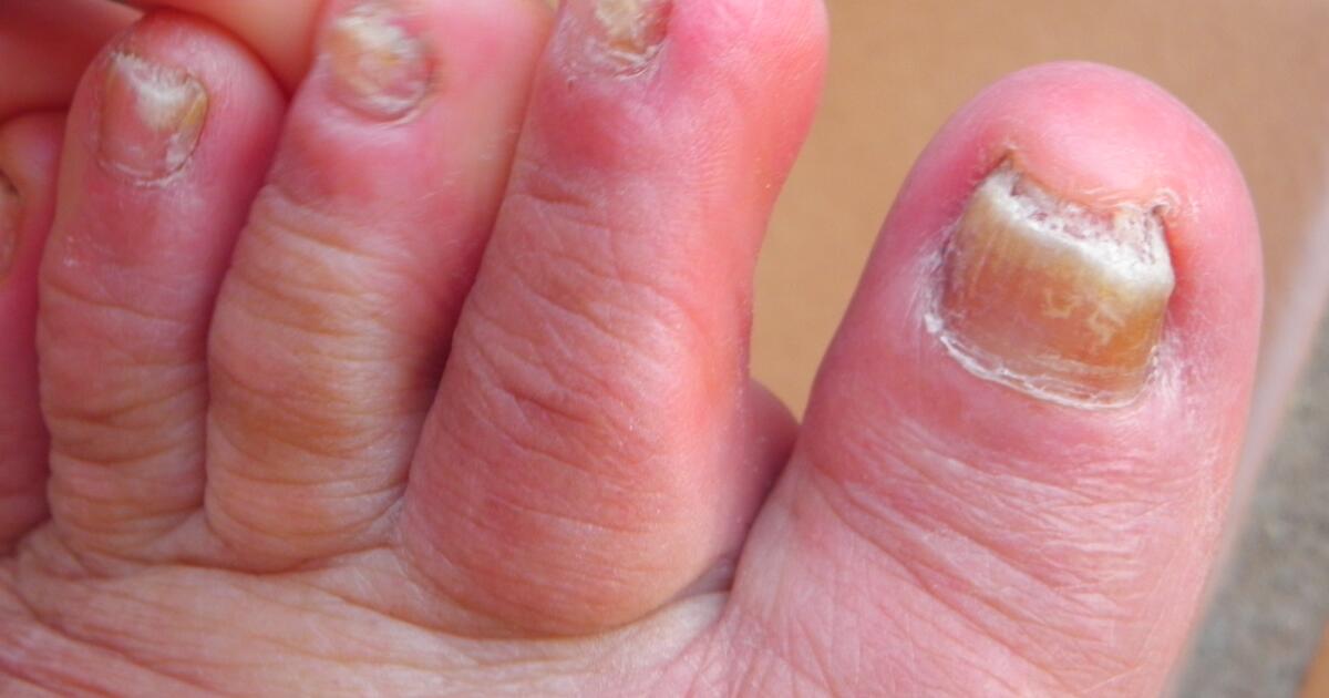 Toenail Fungus Pictures Treatment Home Remedies Medication
