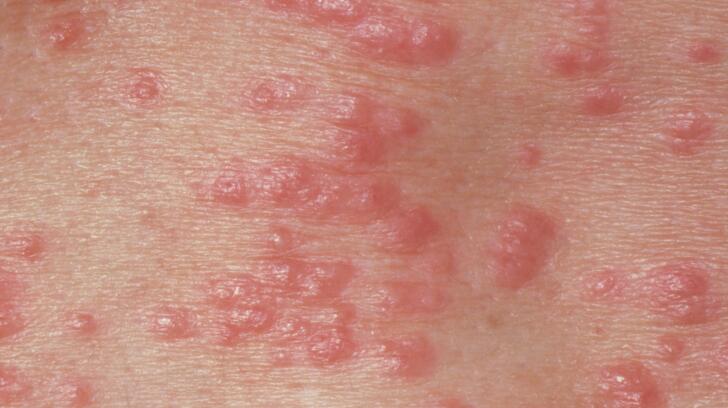 10 Things To Know About Scabies Skin Mites