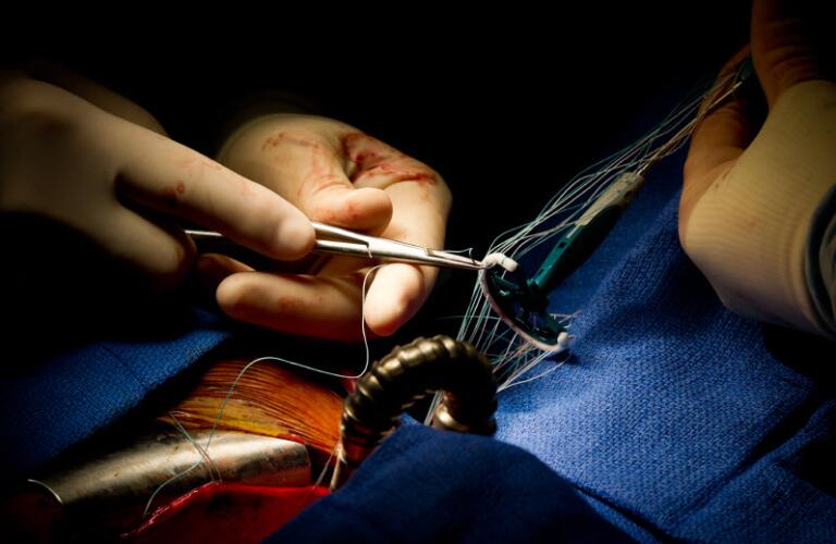 heart, heart surgery, blood, pump, open heart, cardiac, mitral valve, aortic stenosis