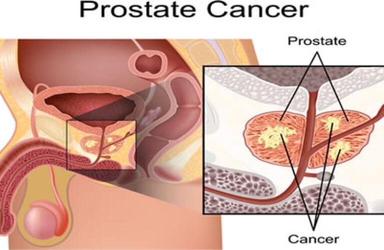 Prostatectomy