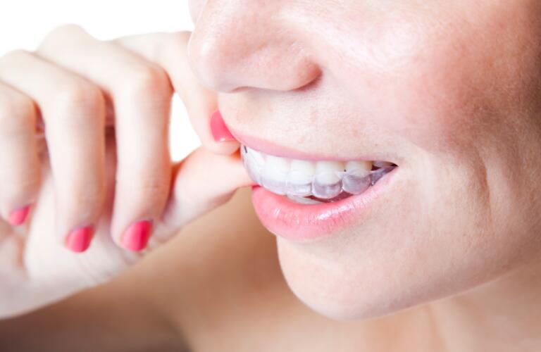Clear Braces