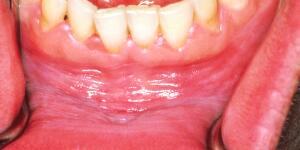 Mouth Cancer Pictures What Oral Cancer Sores Look Like