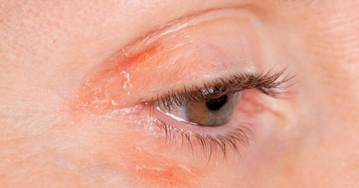 Face Psoriasis What to Do for Psoriasis Near Eyes
