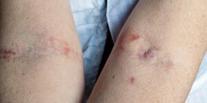 Hidradenitis Suppurativa Symptoms Eczema Complications