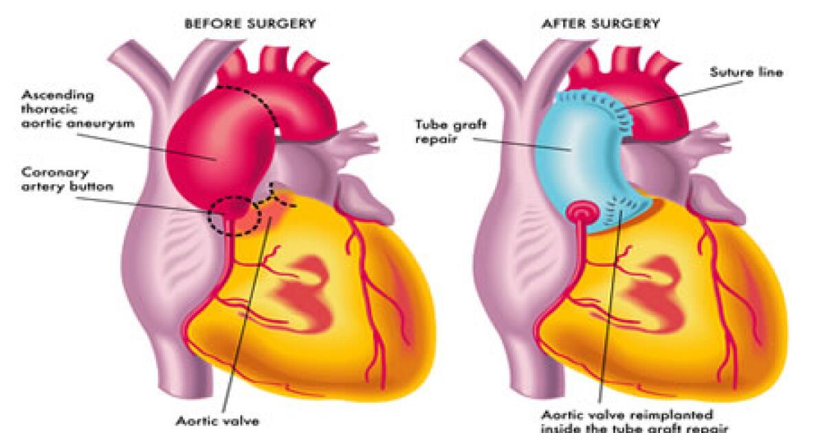 Aortic Aneurysm Repair Thoracic Artery