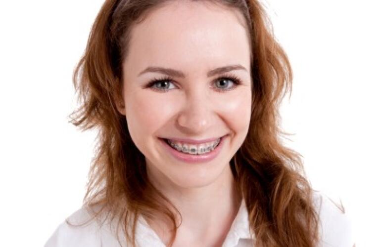Dental Braces