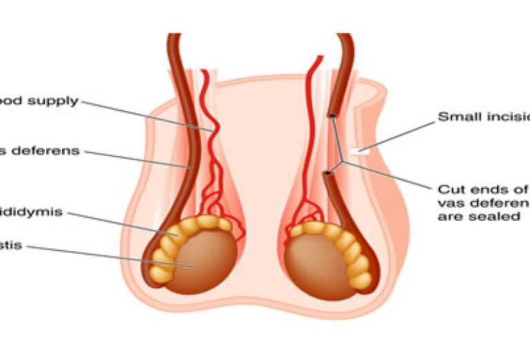 Vasectomy: How It's Done, Risks, What to Expect Vasectomy: How It's Done, Risks, What to Expect