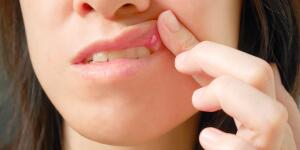 Oral And Mouth Cancer Signs Symptoms