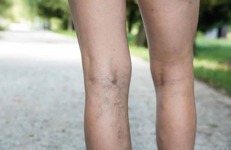 Varicose Vein Surgery Varicose Veins Treatment