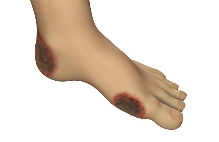 Diabetic foot ulcer illustration