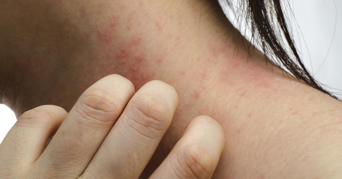 does heat rash itch more at night