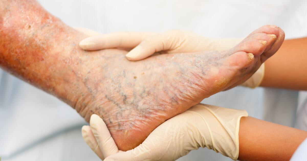 Phlebectomy Vein Removal