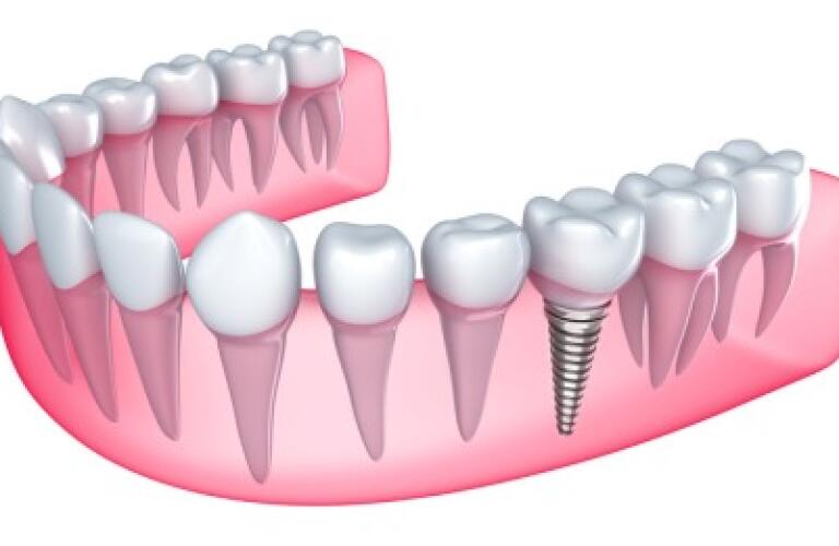 Dental Implants