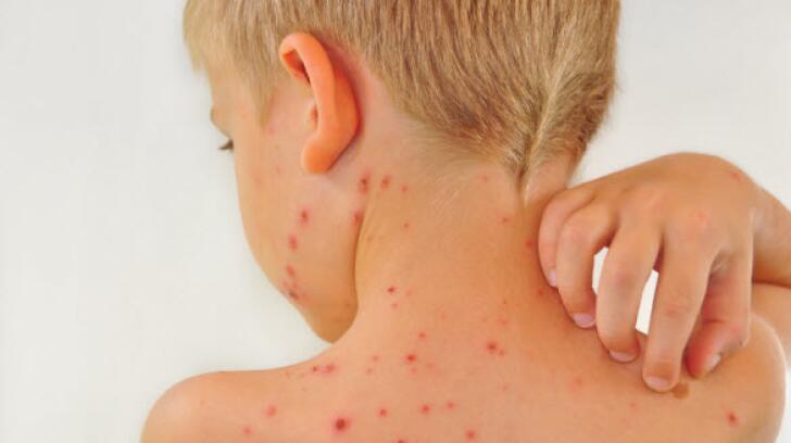 12 Things To Know About Shingles