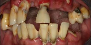 Mouth Cancer Pictures What Oral Cancer Sores Look Like