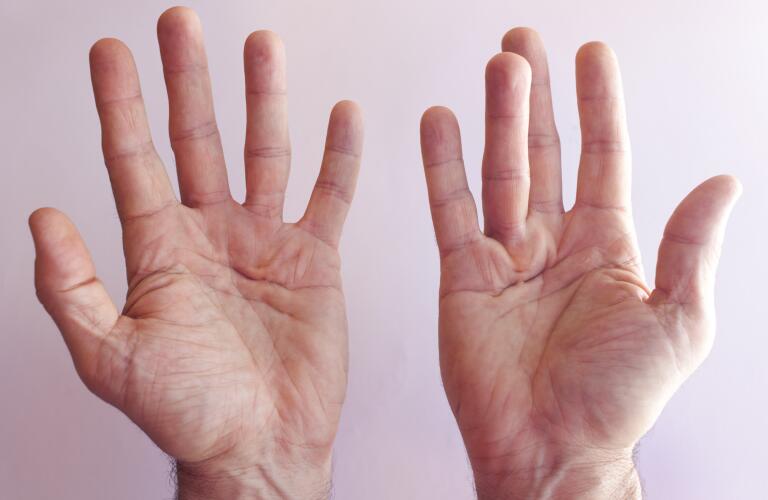hands of man with dupuytren contracture