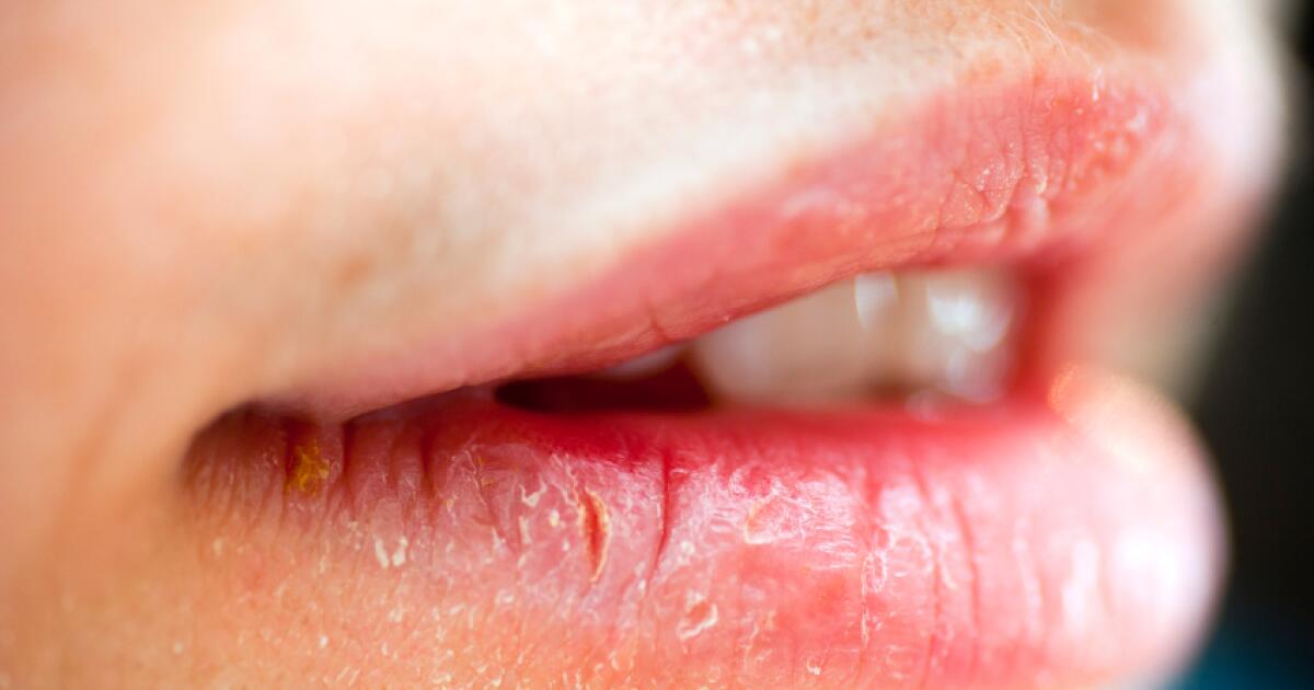 What Is A Lip Sore Blister On Lip Lip Bumps Lesions
