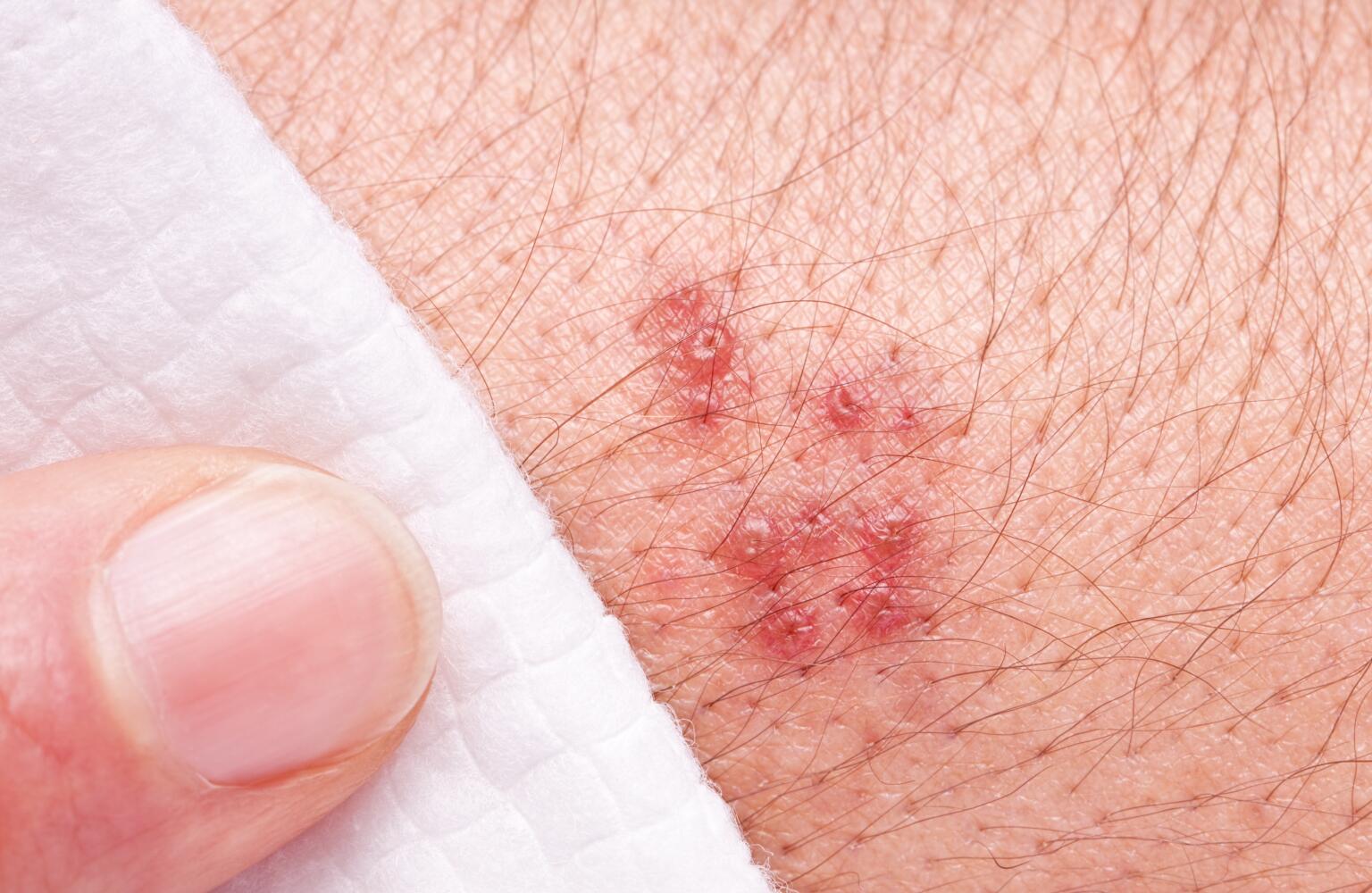 Shingles Symptoms Pictures Risk Factors And Treatment