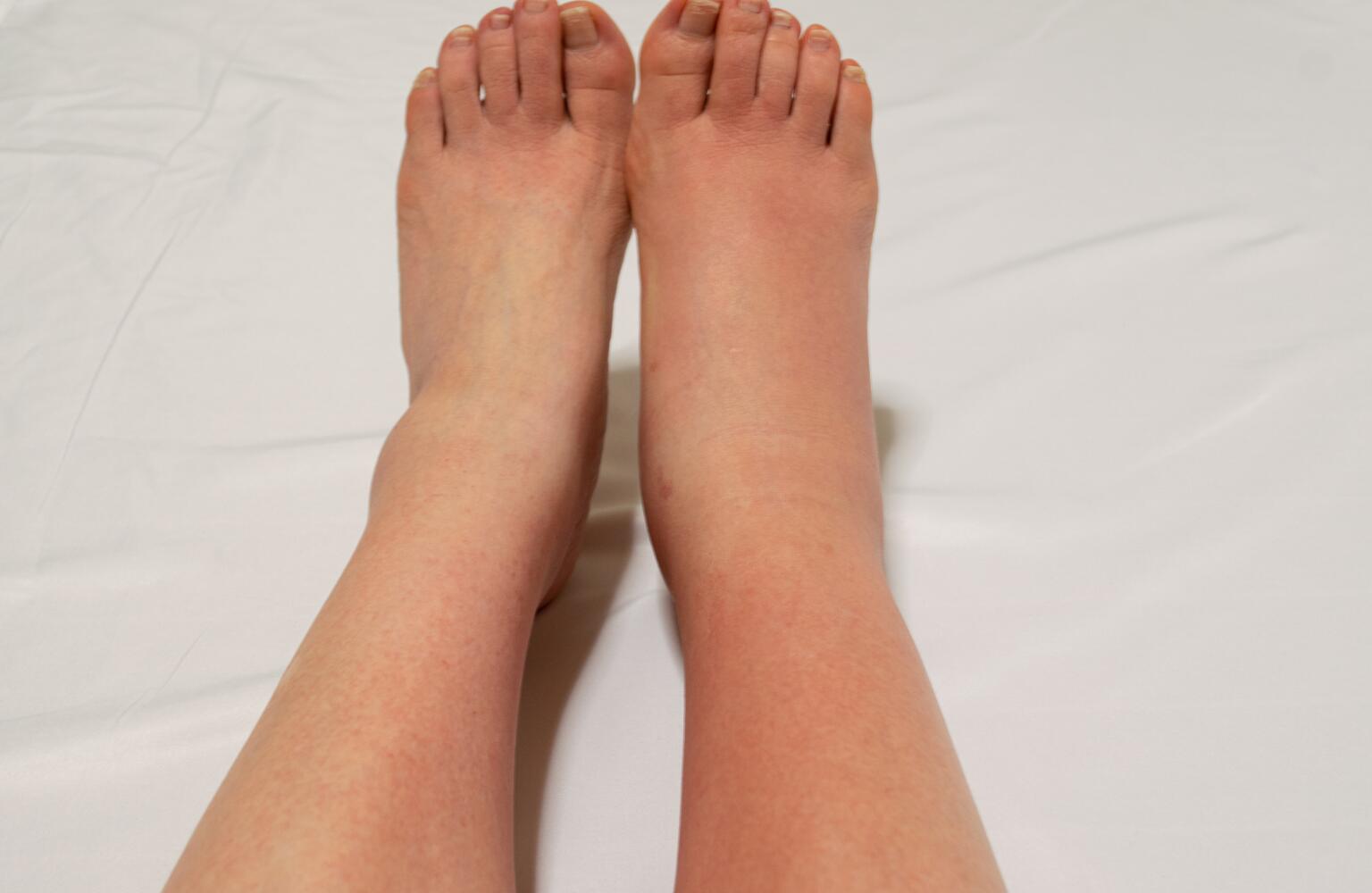 does cellulitis itch