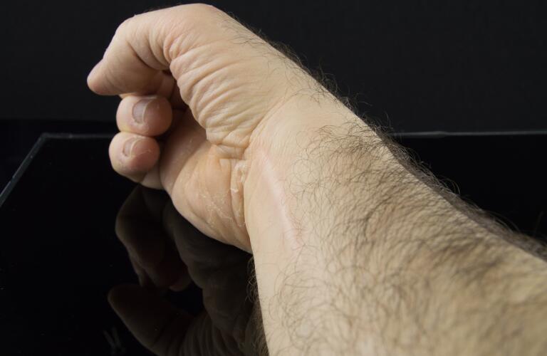 man with cracked skin and scar on hand