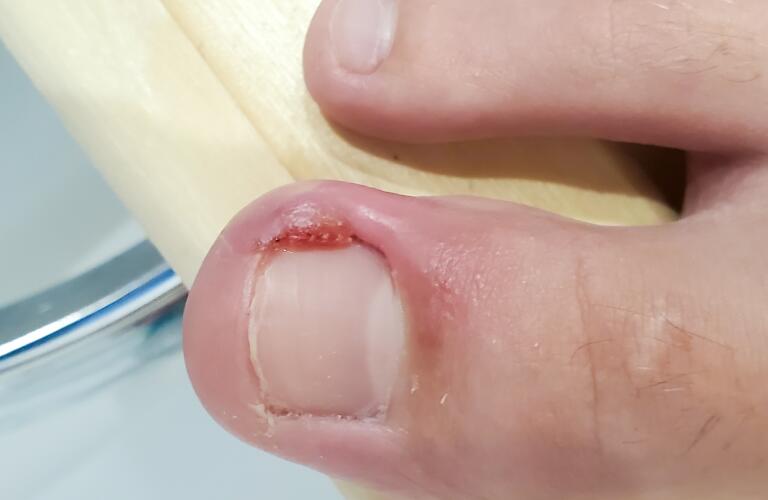 Toenail Problems Fungus, Thickening & Yellow Toenails